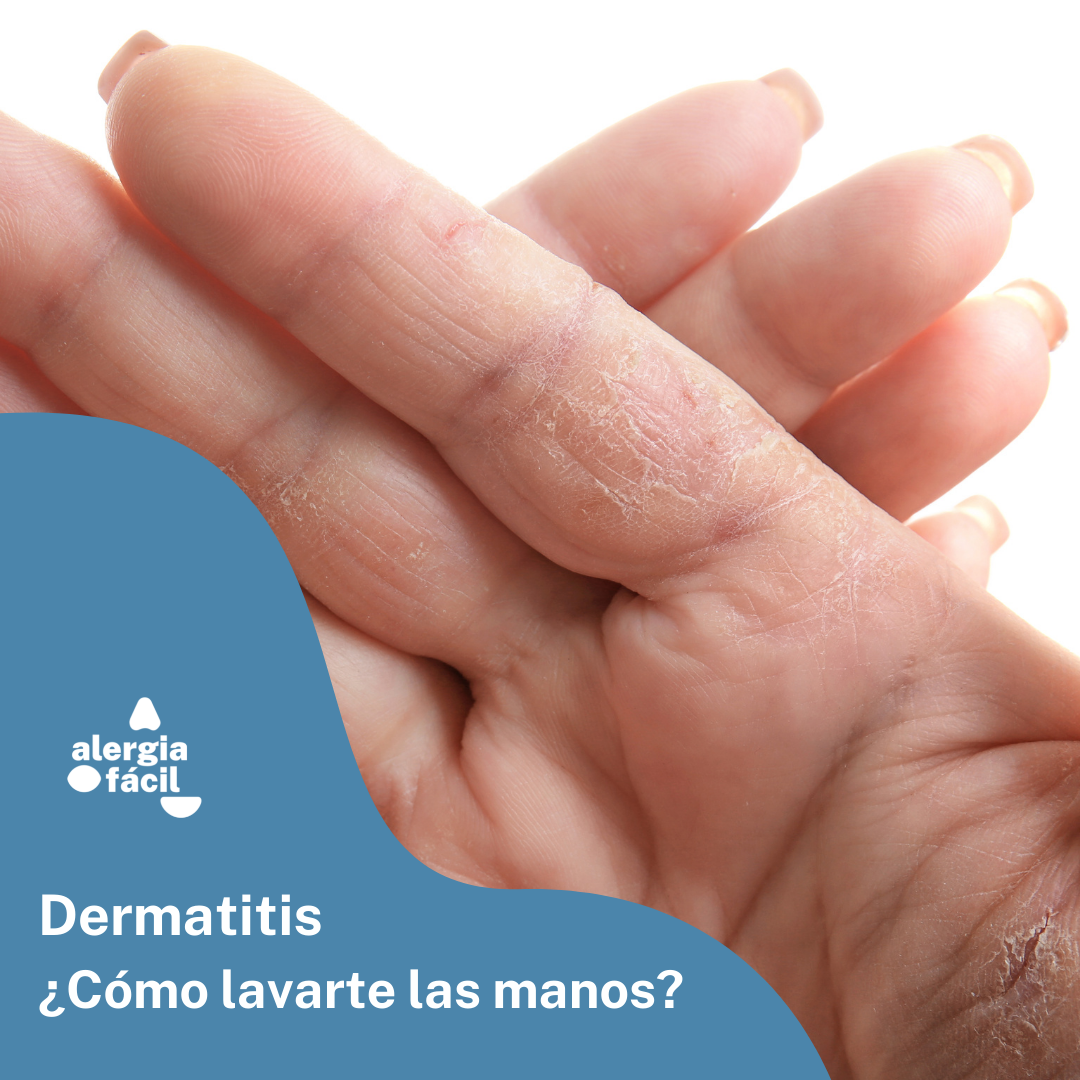 Dermatitis de manos